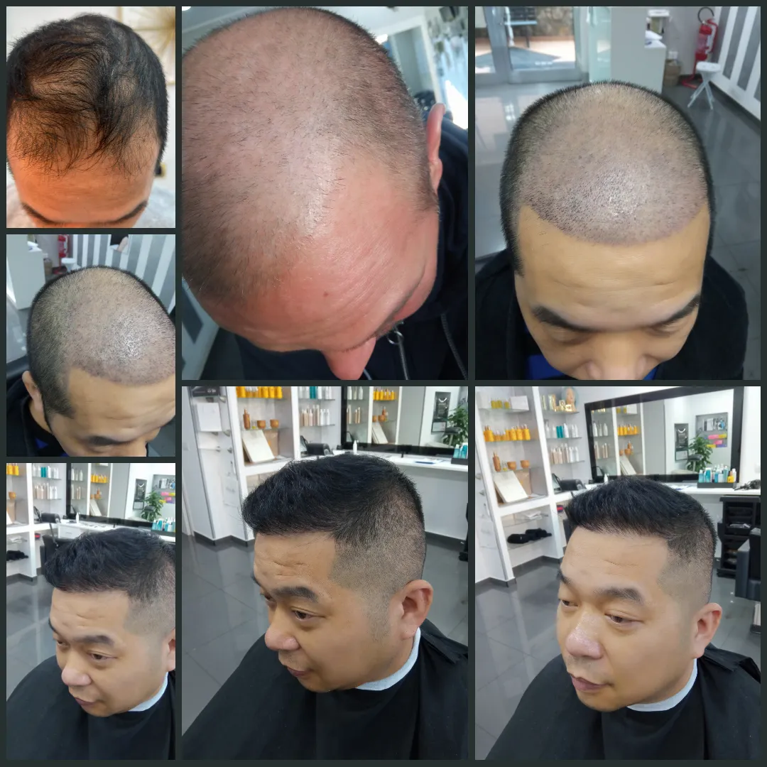 Centro consulenza Trapianto Capelli istanbul · Foto 5